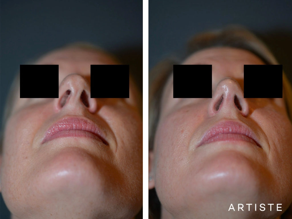 41 Years Old Total Nose Rhinoplasty