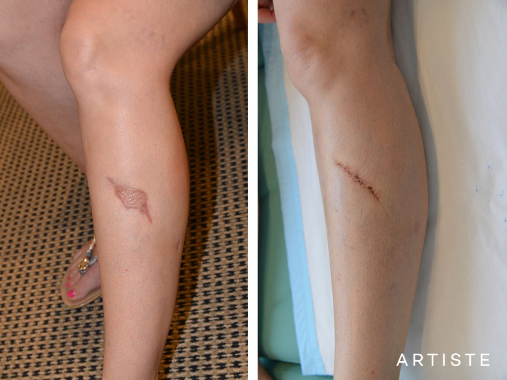 42 Year Old Scar Revision of Skin Graft