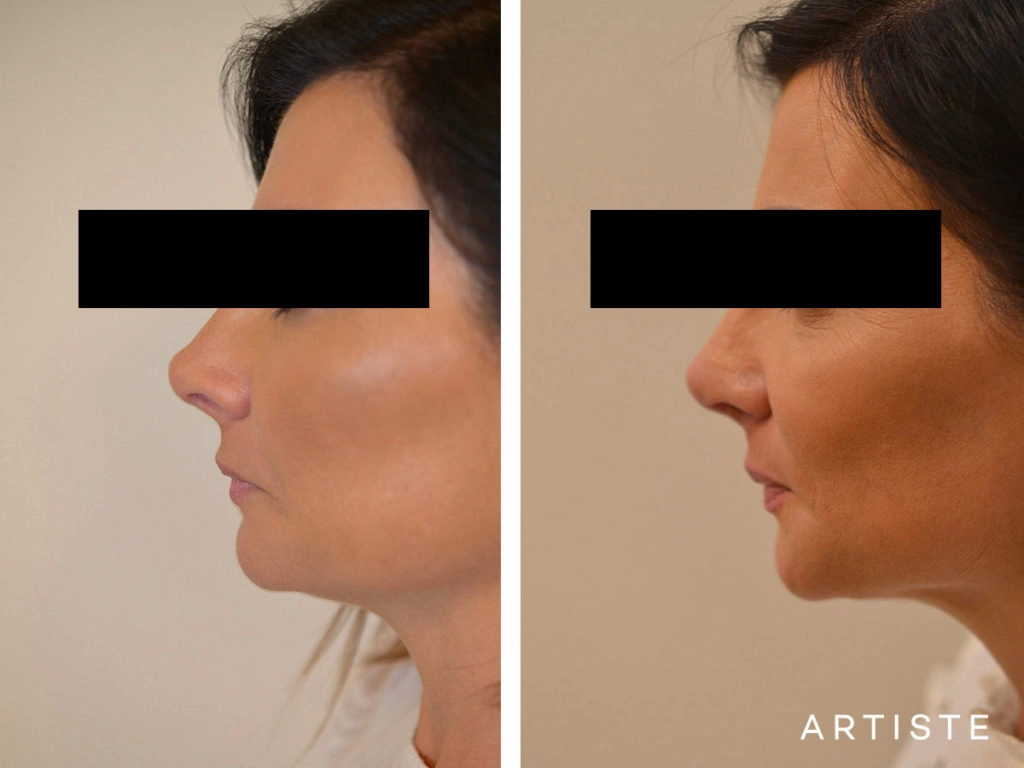 42 Years Old Rib Graft Tertiary Rhinoplasty