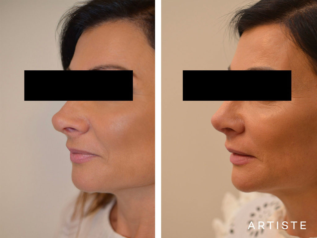 42 Years Old Rib Graft Tertiary Rhinoplasty