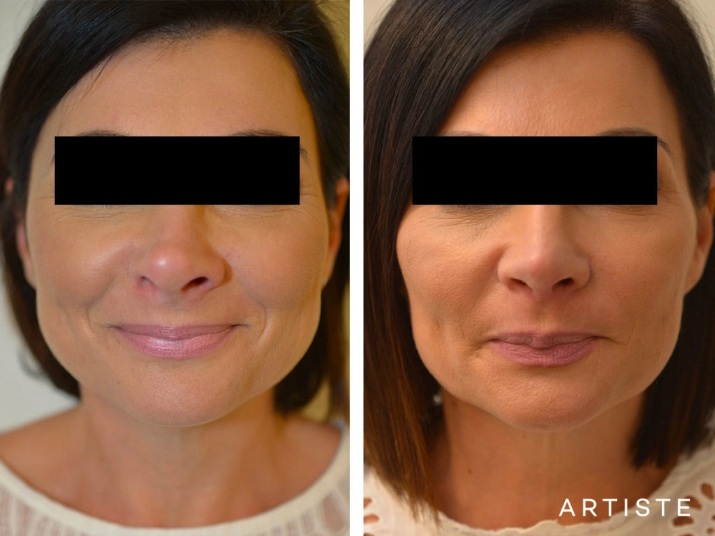 42 Years Old Rib Graft Tertiary Rhinoplasty