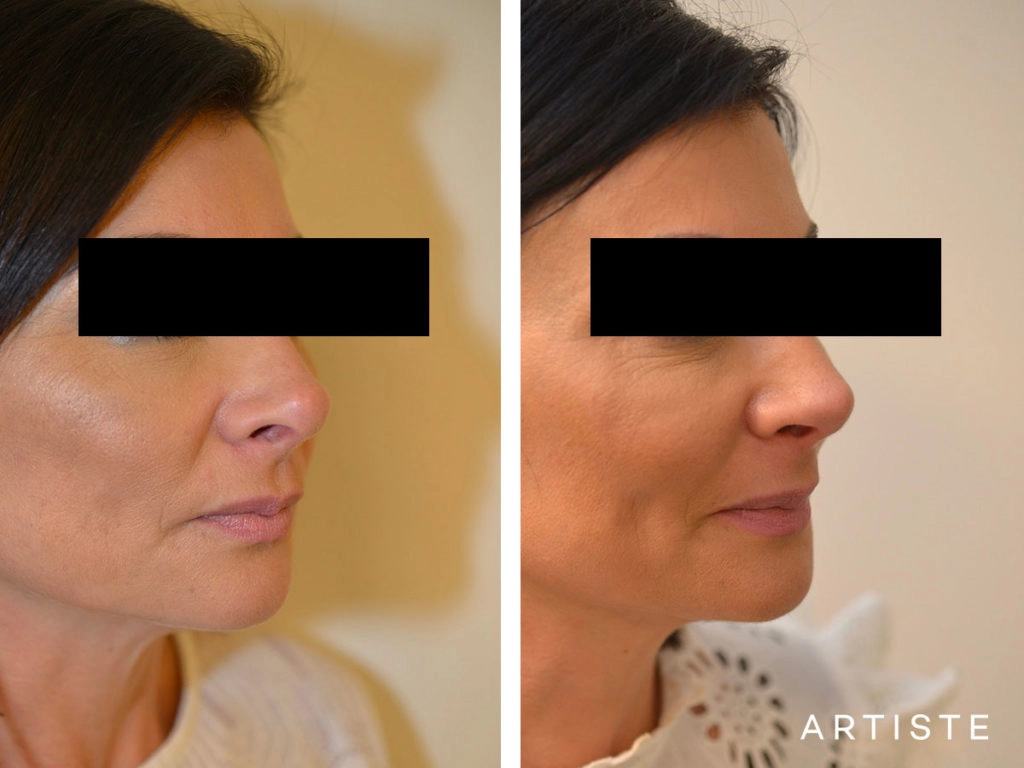 42 Years Old Rib Graft Tertiary Rhinoplasty