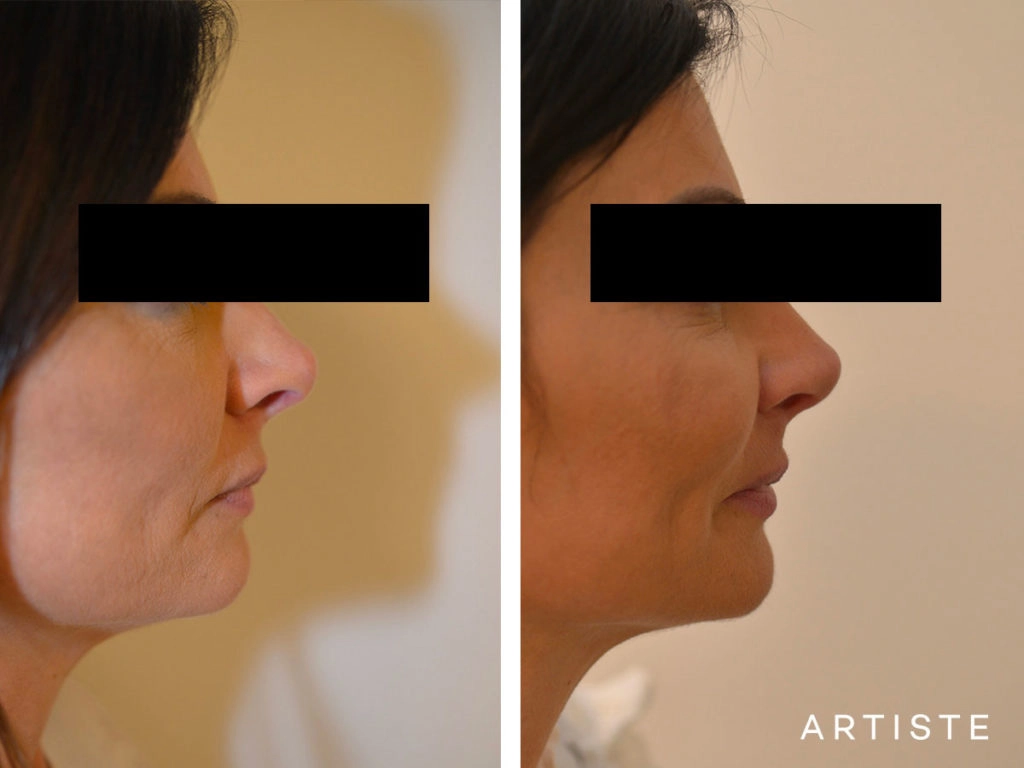 42 Years Old Rib Graft Tertiary Rhinoplasty