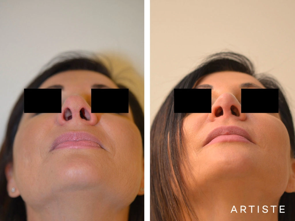 42 Years Old Rib Graft Tertiary Rhinoplasty