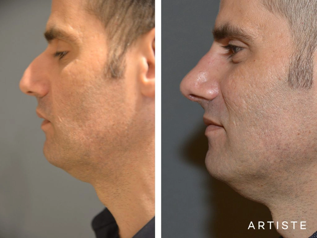 46 Years Old Shape (Dorsal Reduction) Rhinoplasty