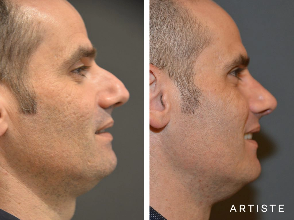 46 Years Old Shape (Dorsal Reduction) Rhinoplasty