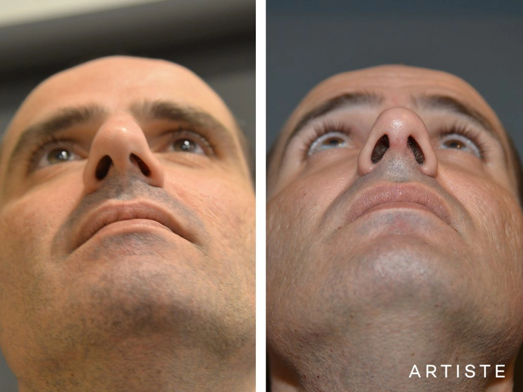 46 Years Old Shape (Dorsal Reduction) Rhinoplasty