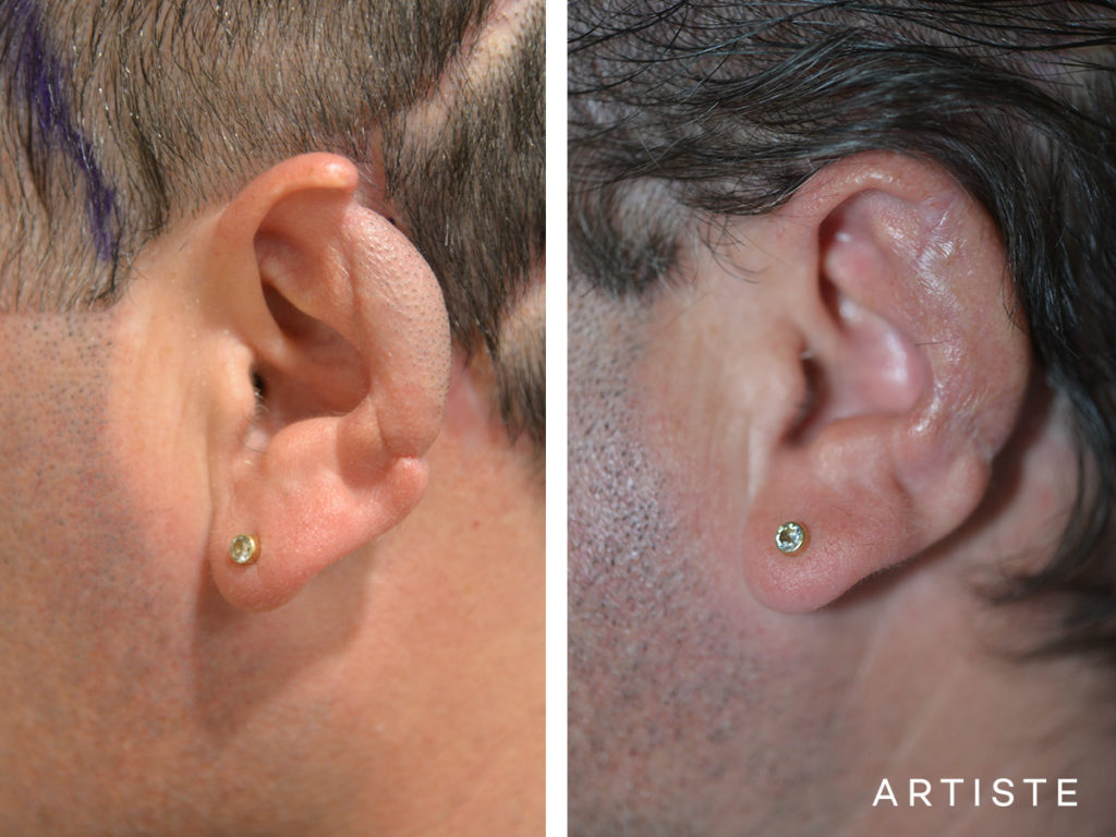 47 Year Old Partial Ear Reconstruction Fascia Flap