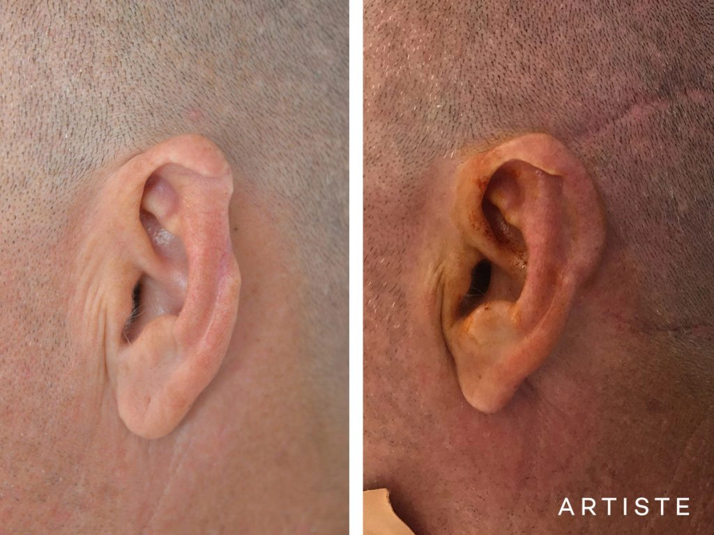 47 Year Old Partial Ear Reconstruction Trauma