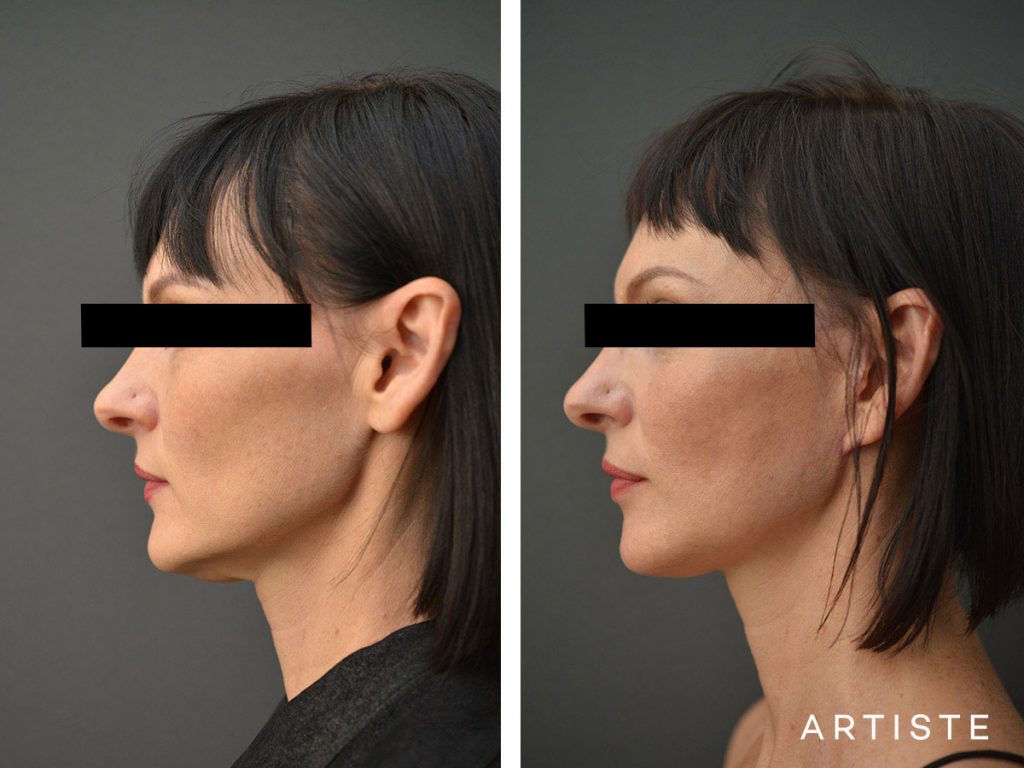 47 Year Old Artiste Short Scar Facelift: Short Scar SMASectomy, Chemical Peel