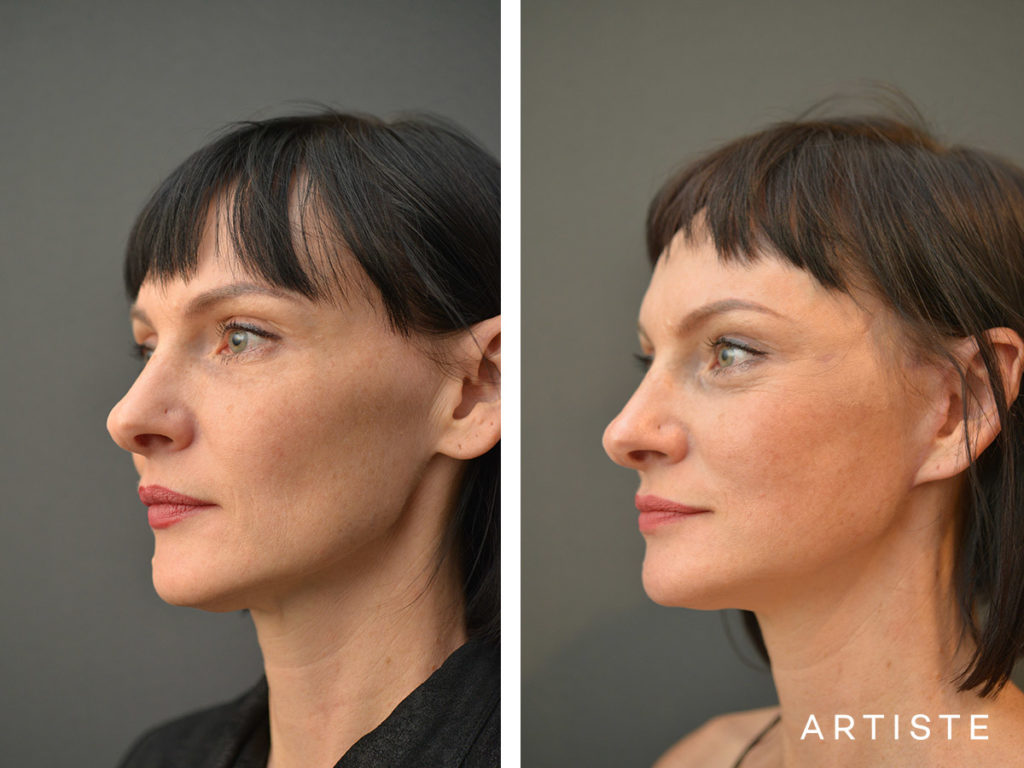 47 year old short scar facelift 49 year old s