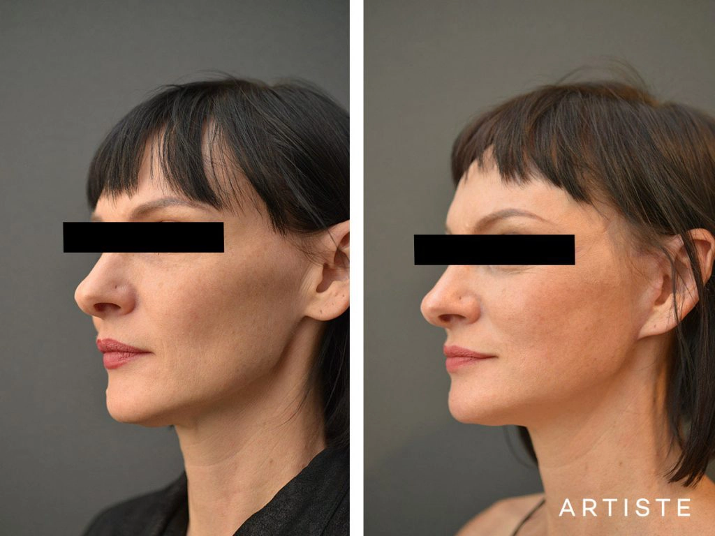 47 Year Old Artiste Short Scar Facelift: Short Scar SMASectomy, Chemical Peel