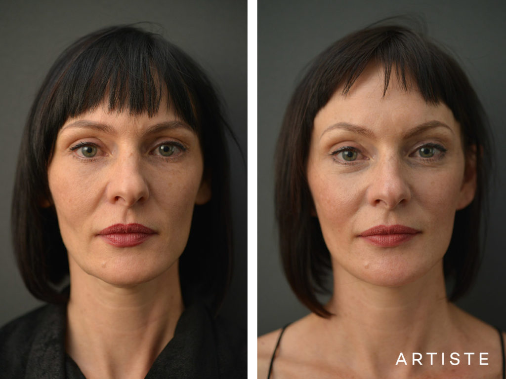 47 year old short scar facelift 49 year old s
