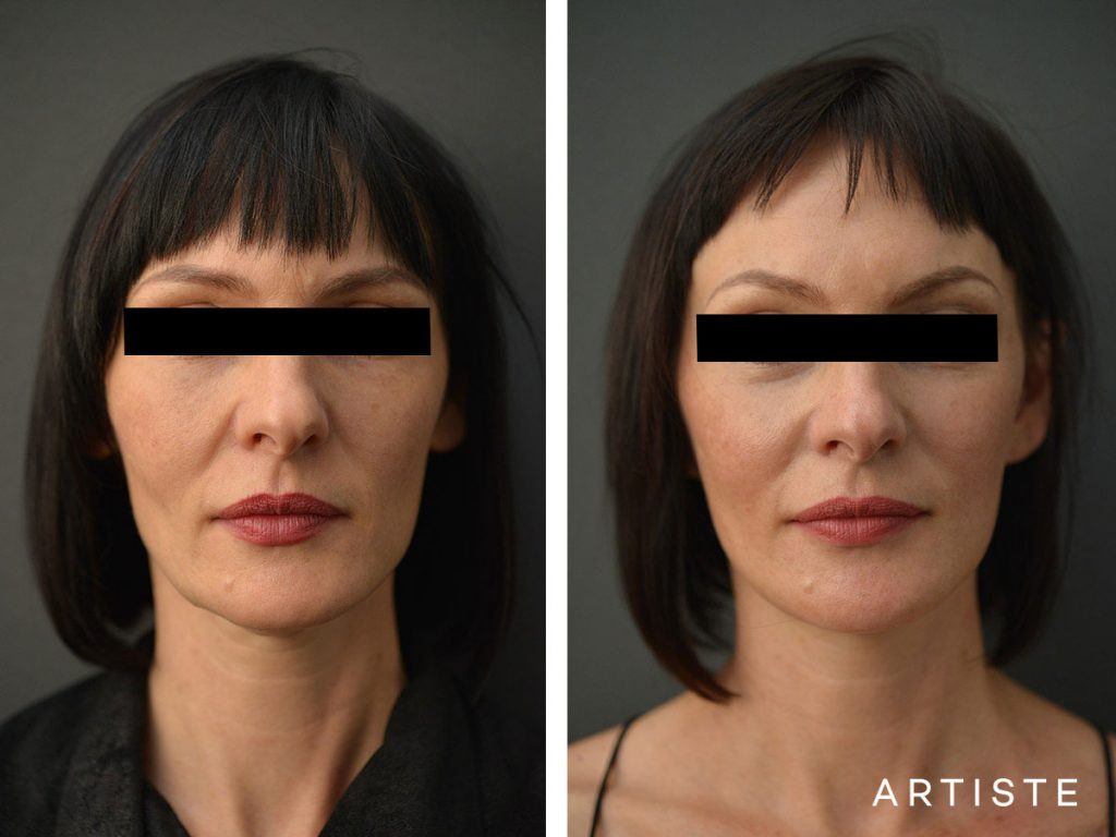 47 Year Old Artiste Short Scar Facelift: Short Scar SMASectomy, Chemical Peel