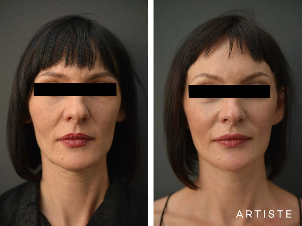 47 Year Old Artiste Short Scar Facelift: Short Scar SMASectomy, Chemical Peel