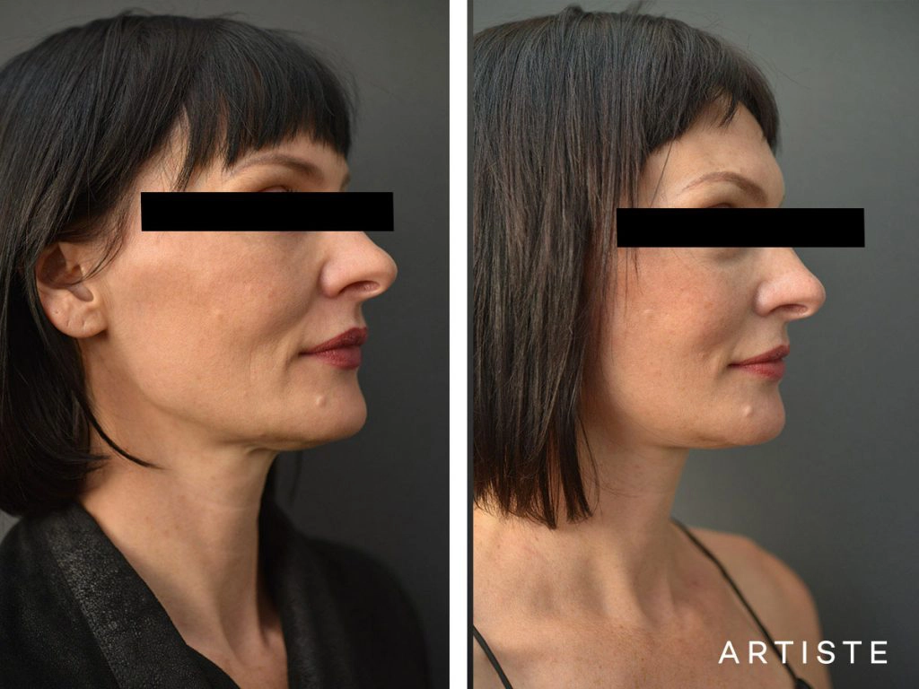 47 Year Old Artiste Short Scar Facelift: Short Scar SMASectomy, Chemical Peel