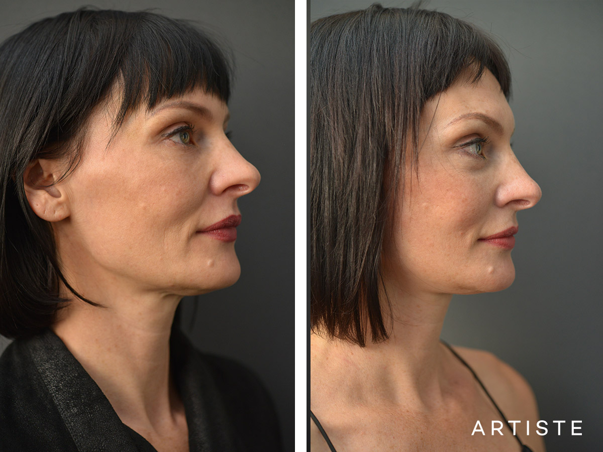 47 year old short scar facelift 49 year old s
