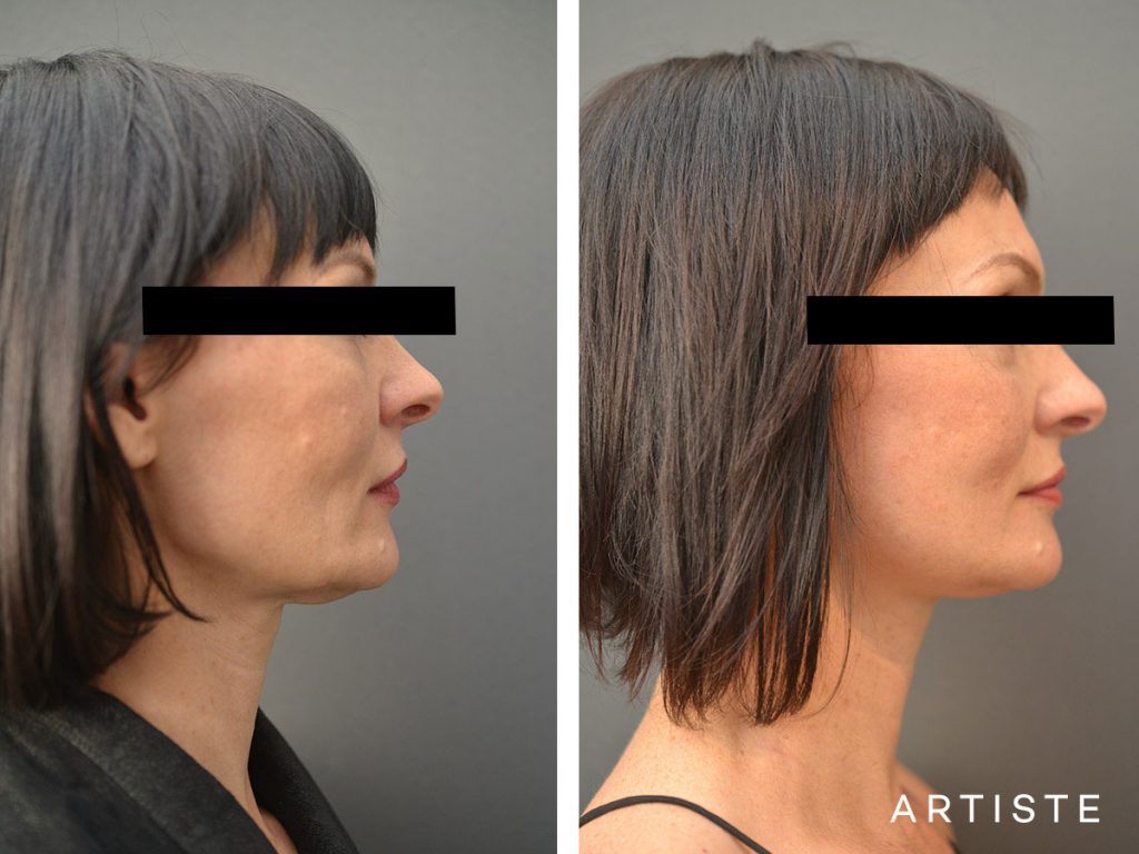 47 Year Old Short Scar Facelift