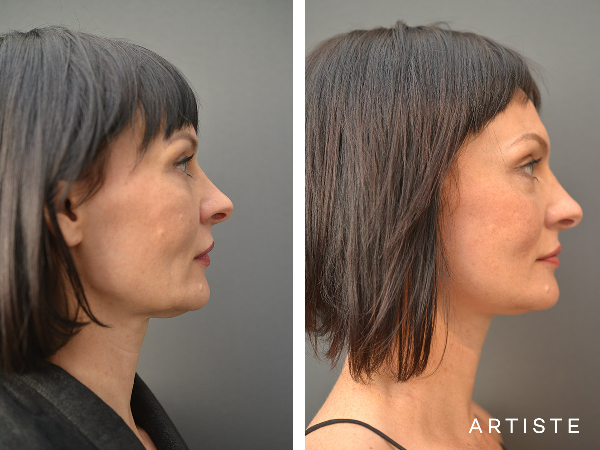 47 year old short scar facelift 49 year old s