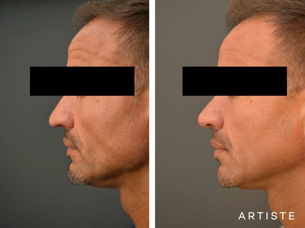 48 Years Old Rib Graft Rhinoplasty