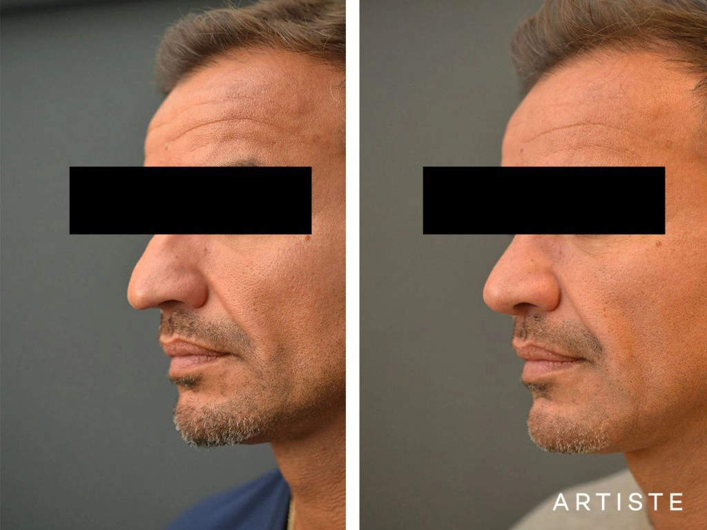 48 Years Old Rib Graft Rhinoplasty