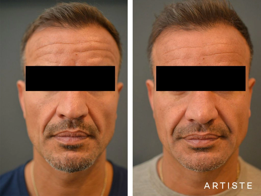 48 Years Old Rib Graft Rhinoplasty