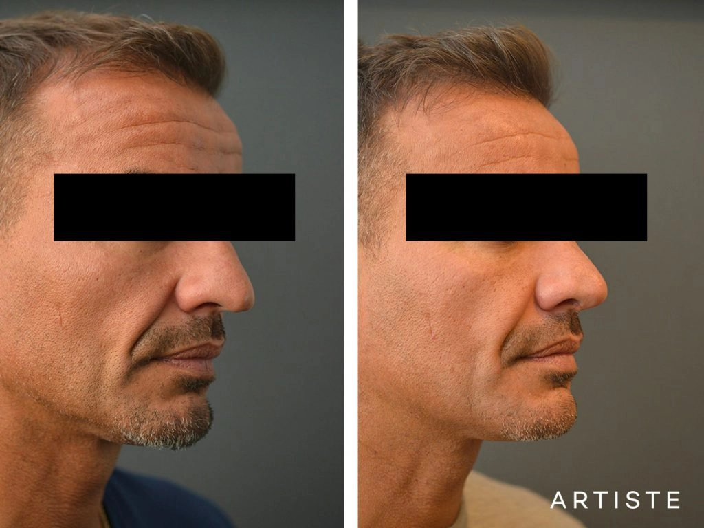 48 Years Old Rib Graft Rhinoplasty