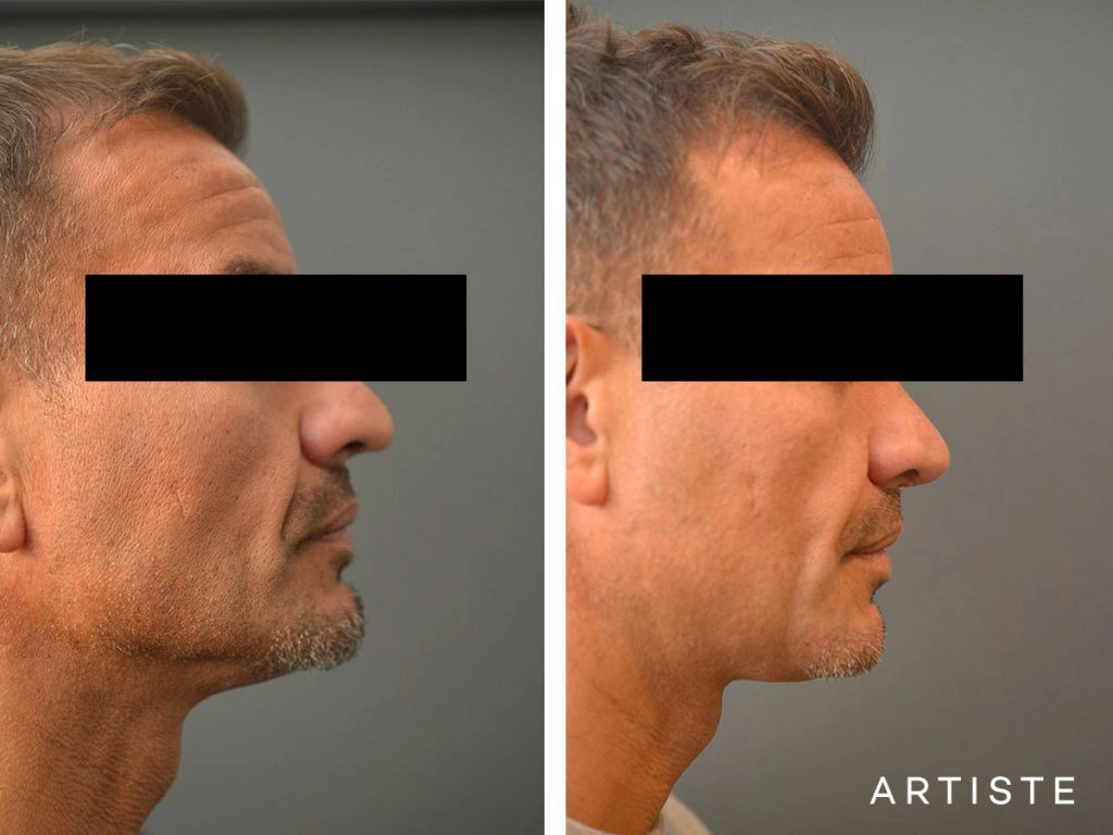 48 Years Old Rib Graft Rhinoplasty