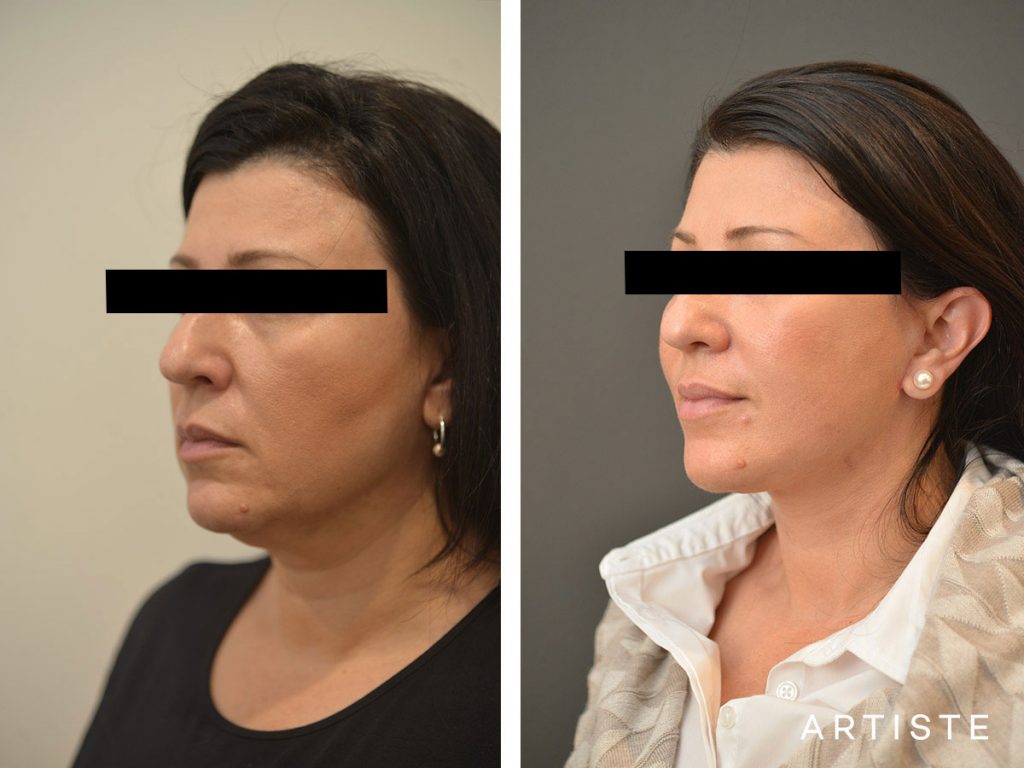 49 Year Old Short Scar Facelift + Neck Liposuction