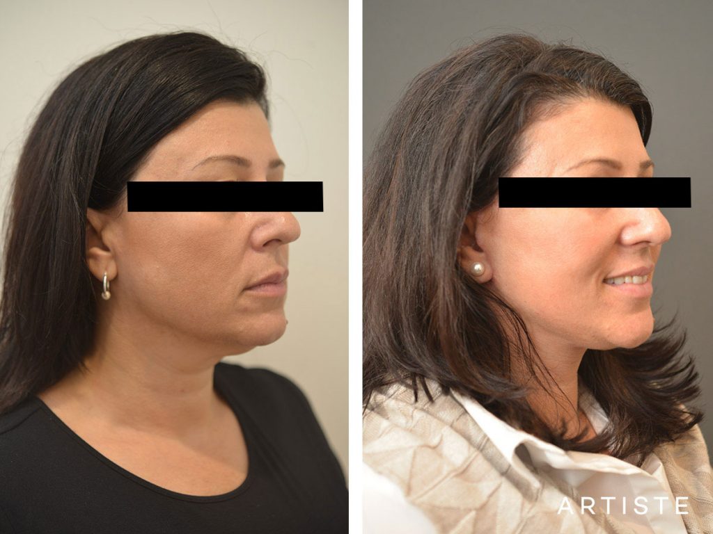 49 Year Old Short Scar Facelift + Neck Liposuction
