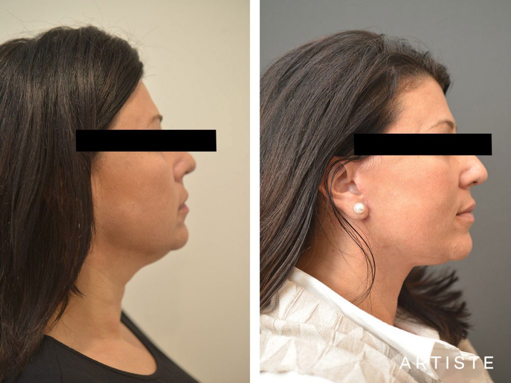 49 Year Old Short Scar Facelift + Neck Liposuction