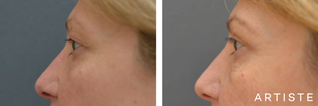 49 Year Old Upper Eyelid Open Eye Surgery-Blepharoplasty