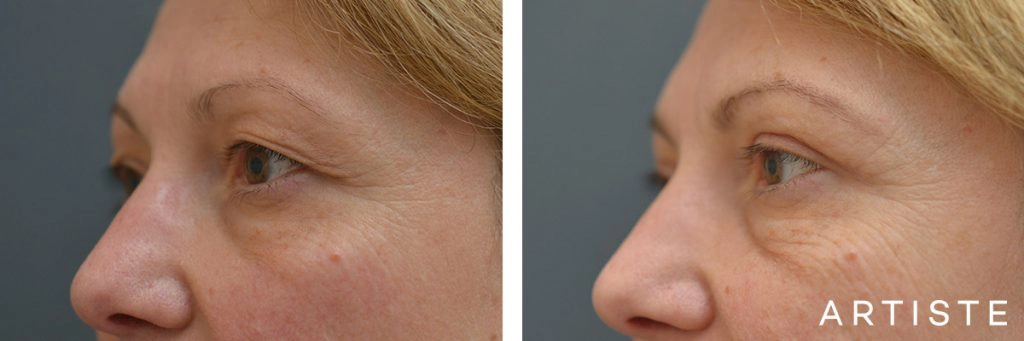 49 Year Old Upper Eyelid Open Eye Surgery-Blepharoplasty