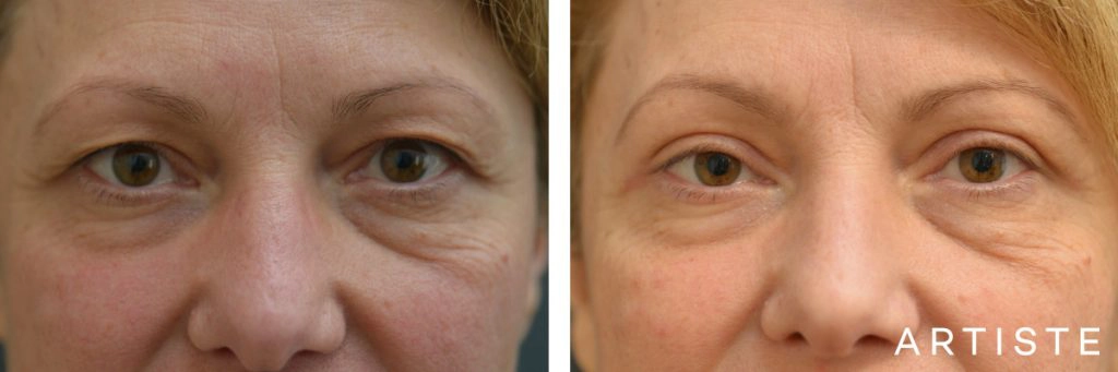 49 Year Old Upper Eyelid Open Eye Surgery-Blepharoplasty