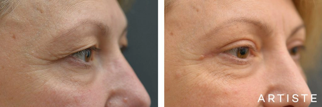 49 Year Old Upper Eyelid Open Eye Surgery-Blepharoplasty