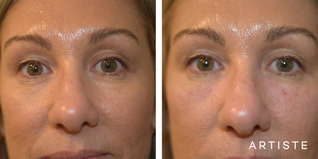 49 Years Old Non Surgical