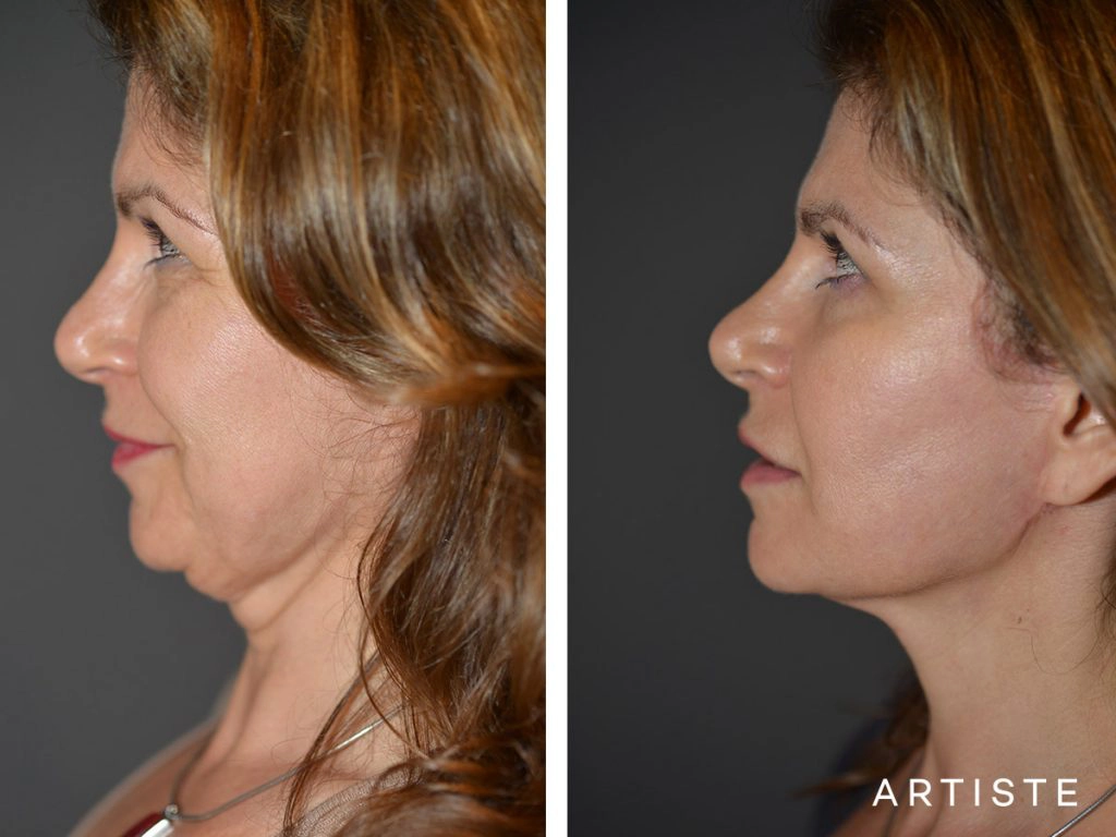 52 Year Old: Deep Plane Facelift, Structural Fat Grafting