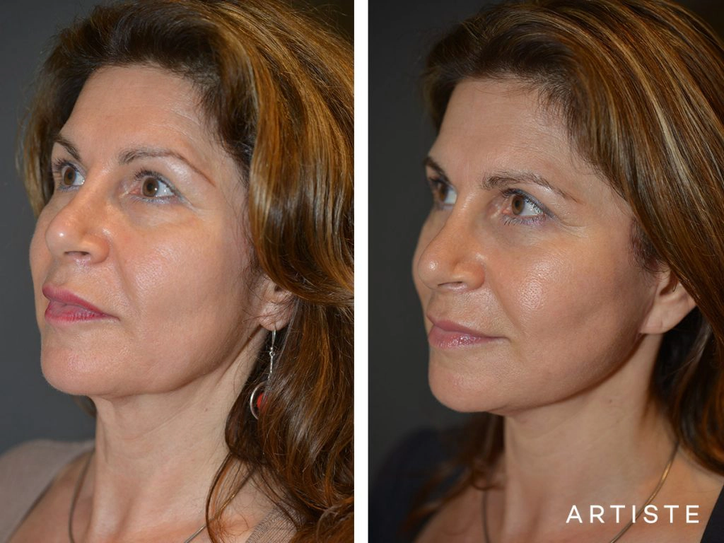 52 Year Old: Deep Plane Facelift, Structural Fat Grafting