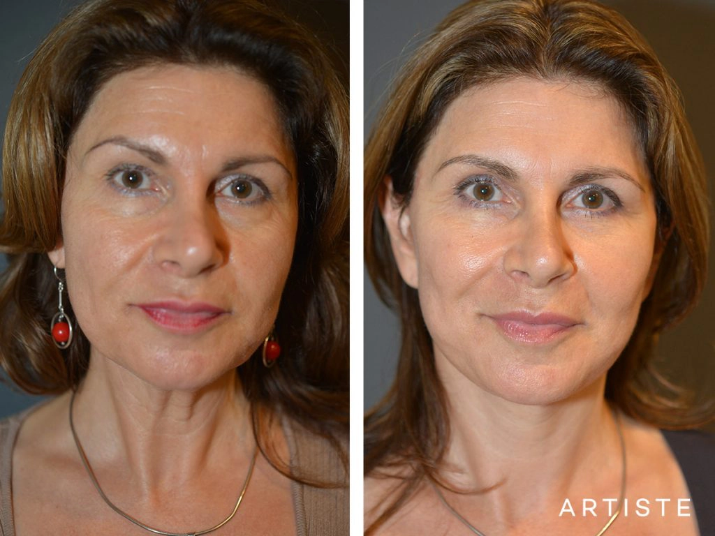 52 Year Old: Deep Plane Facelift, Structural Fat Grafting