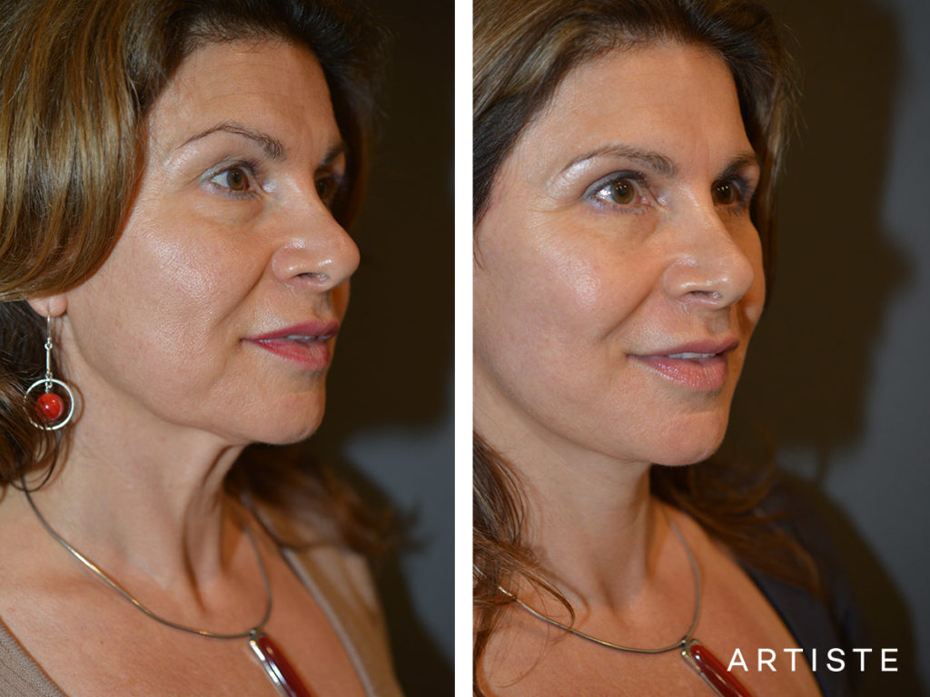 52 Year Old: Deep Plane Facelift, Structural Fat Grafting