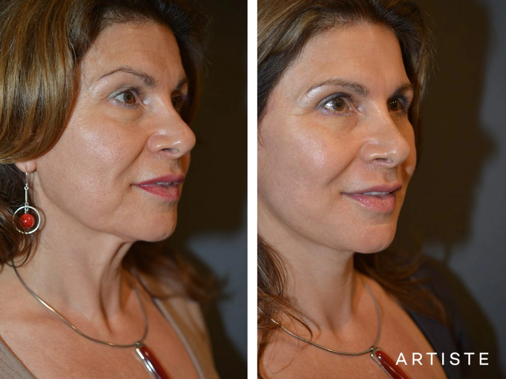 52 Year Old: Deep Plane Facelift, Structural Fat Grafting