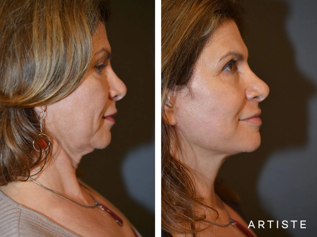 52 Year Old: Deep Plane Facelift, Structural Fat Grafting