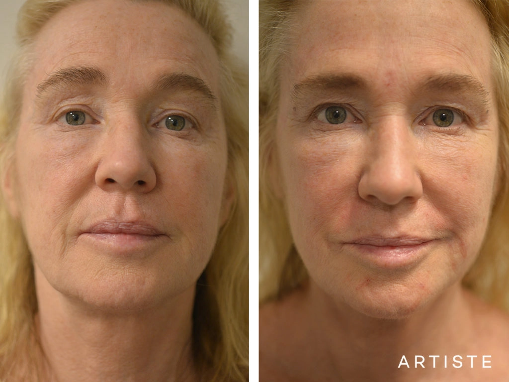 52 Years Old with Naso Labial Filler