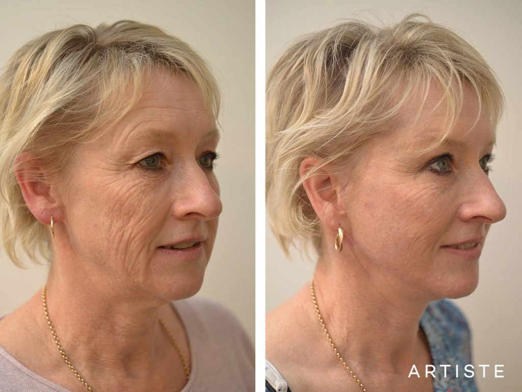 Right Age for Facelift Surgery