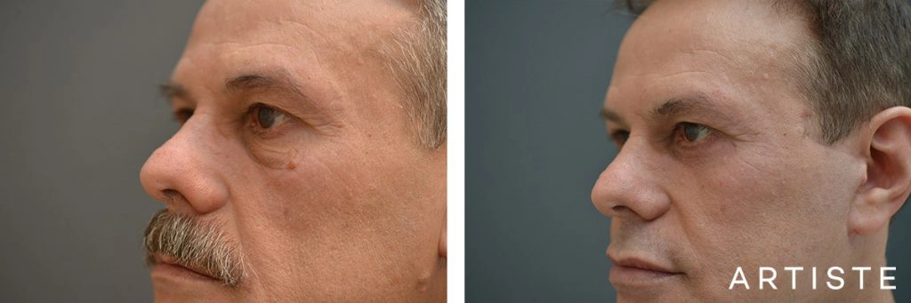 53 Year Old Lower Blepharoplasty + Facelift