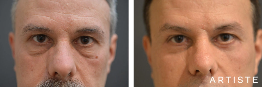 53 Year Old Lower Blepharoplasty + Facelift