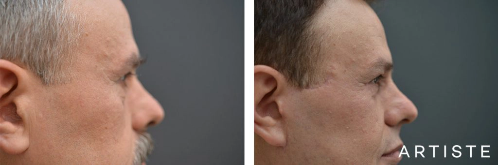 53 Year Old Lower Blepharoplasty + Facelift