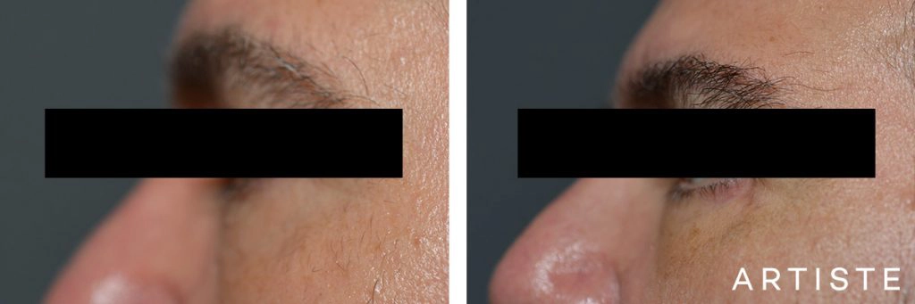 53 Year Old Lower Eyelid Blepharoplasty