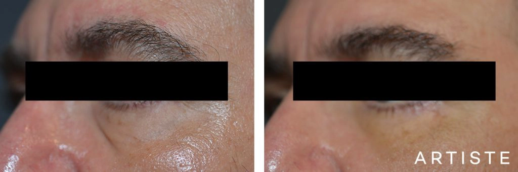 53 Year Old Lower Eyelid Blepharoplasty