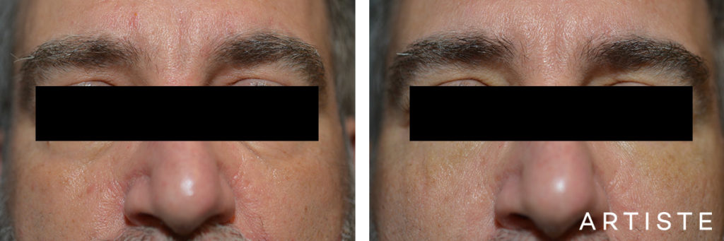53 Year Old Lower Eyelid Blepharoplasty